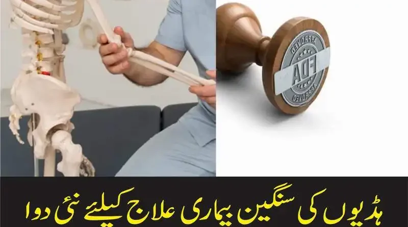 ہڈیوں کی سنگین بیماری علاج کیلئے نئی دوا